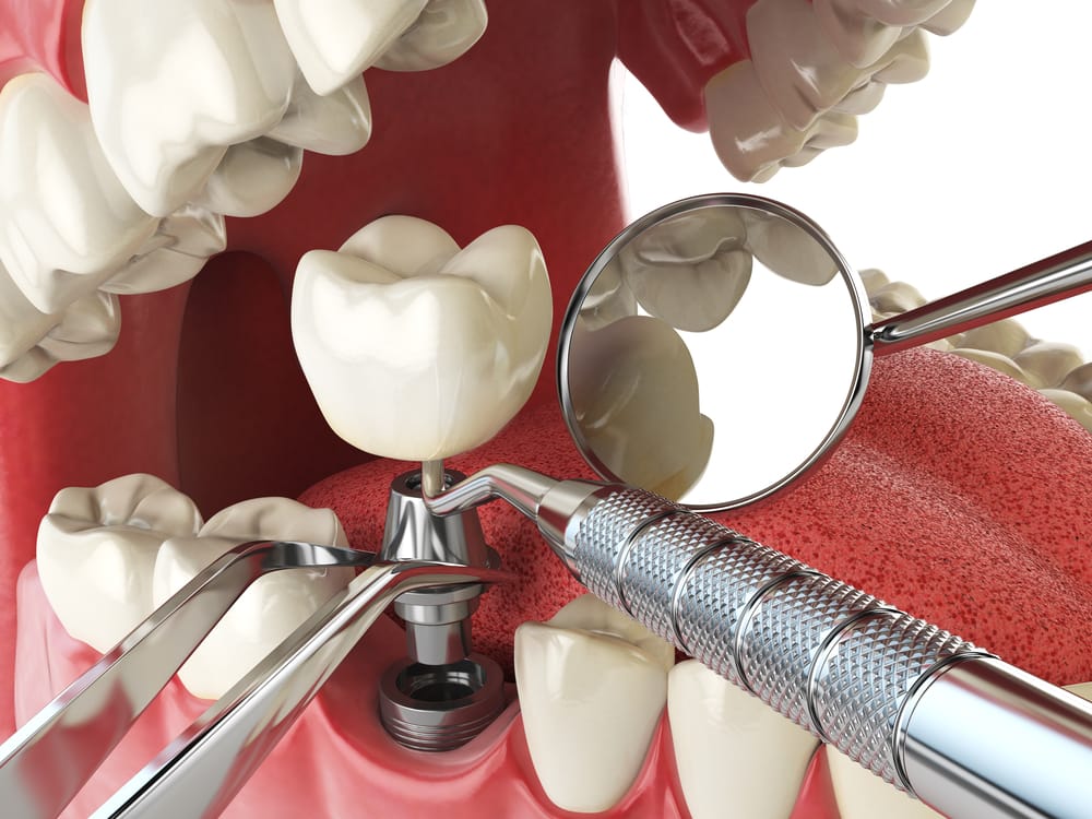 Implantes dentários: preço, tipos, vantagens 1 Implantes dentários